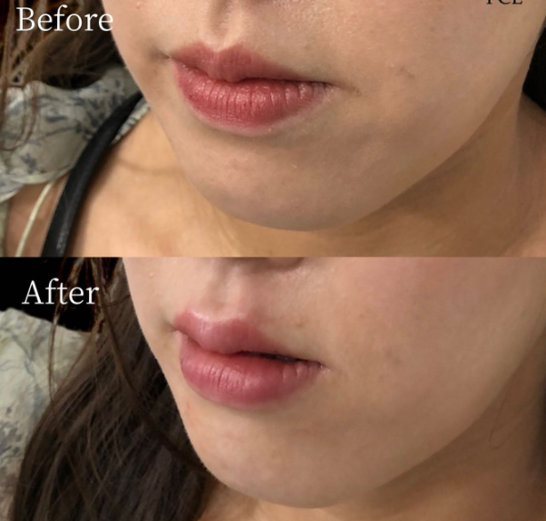 唇ヒアルロン酸 症例⑥