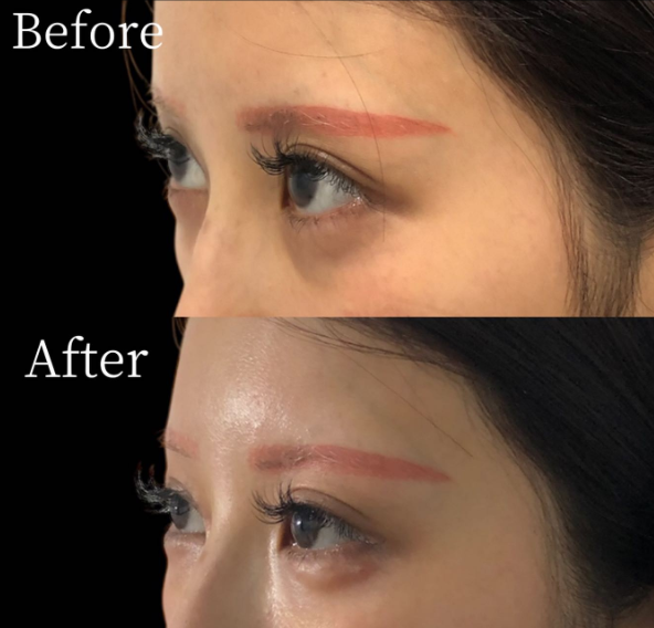 涙袋ヒアルロン酸 症例①