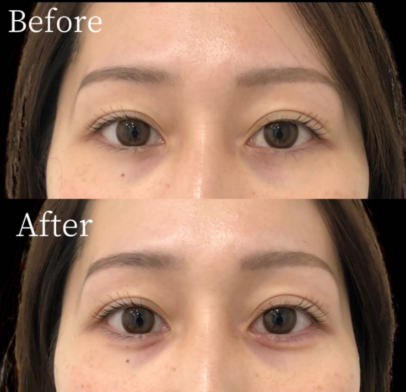 涙袋ヒアルロン酸 症例②