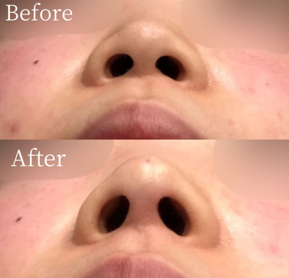 鼻ヒアルロン酸 症例③