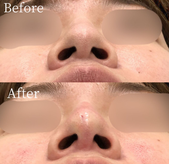 鼻中隔ヒアルロン酸 症例④