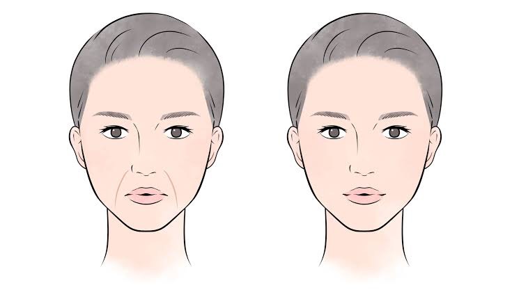 あなたのほうれい線はどのタイプ プライベートクリニック恵比寿