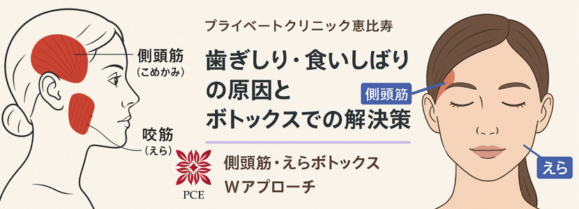 歯ぎしり、食いしばりはボトックスが効果的です。