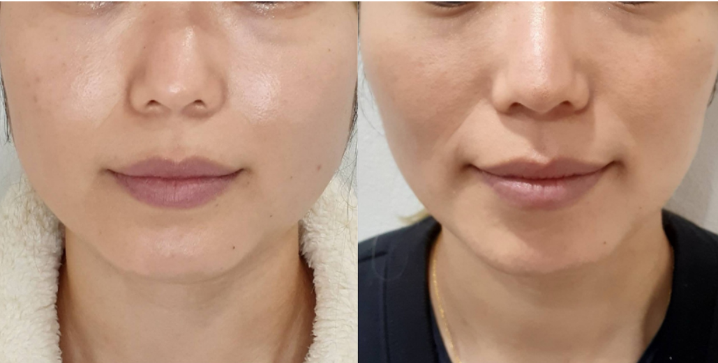 エラボトックス 症例写真 before/after