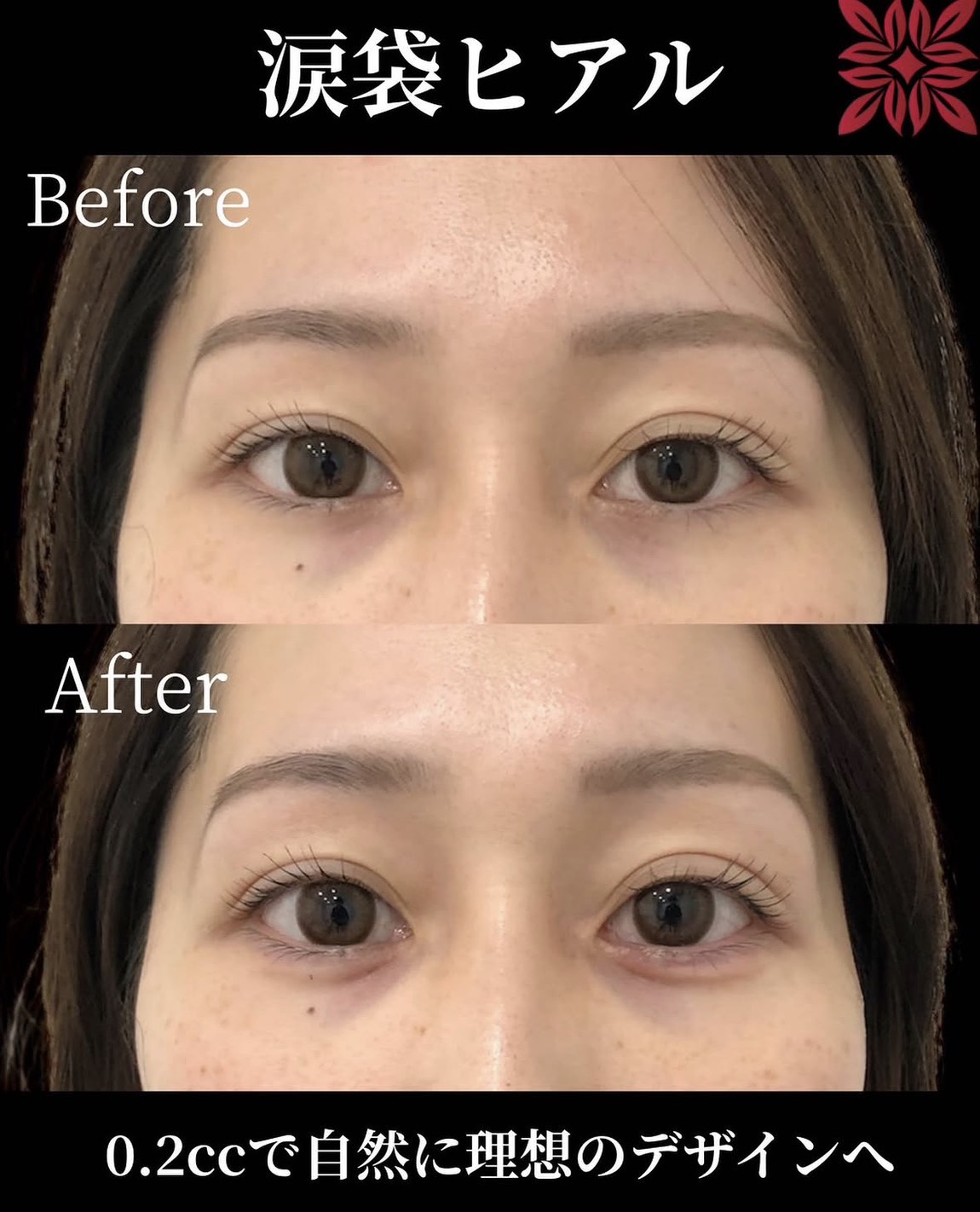 涙袋ヒアルロン酸注入 症例写真（施術前後比較）