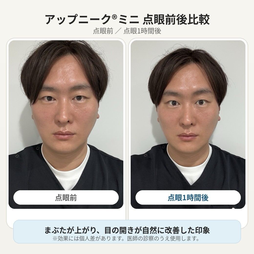 アップニーク®ミニ点眼液 点眼前後の比較写真